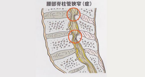 腰部脊柱管狭窄症